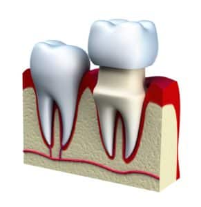 Dental Crowns | Prosthodontics of New York | New York, NY