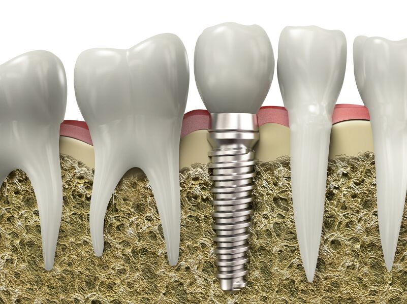 Dental Implants NYC | Tooth Implant Manhattan NY